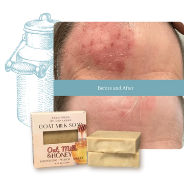 Does Tallow and Goat Milk Soap Help Eczema?